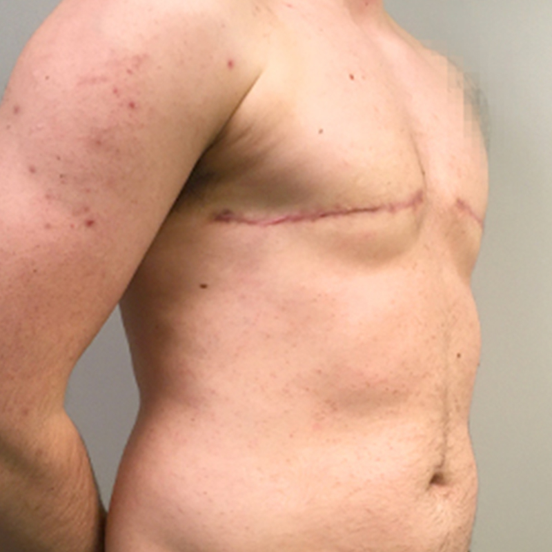 Female To Male Top Surgery 07