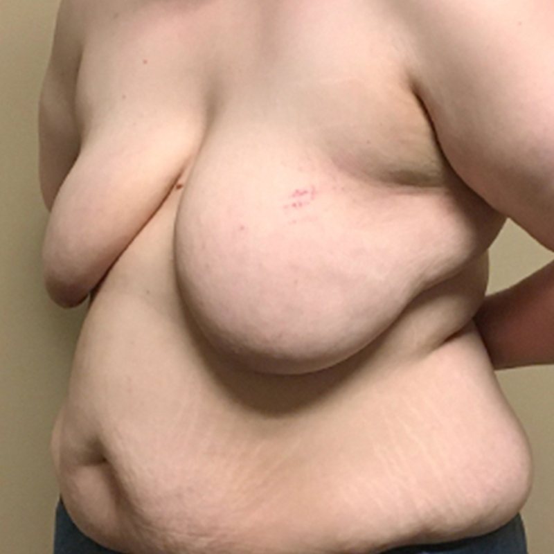 Female To Male Top Surgery 03