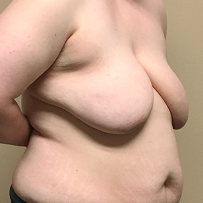 Female To Male Top Surgery 07