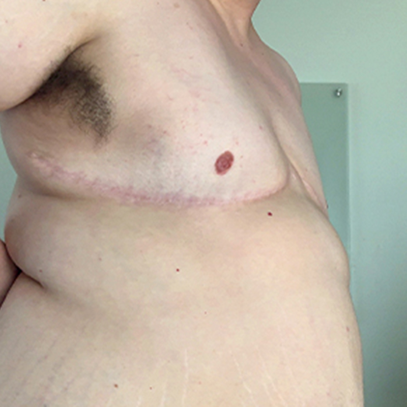 Female To Male Top Surgery 07