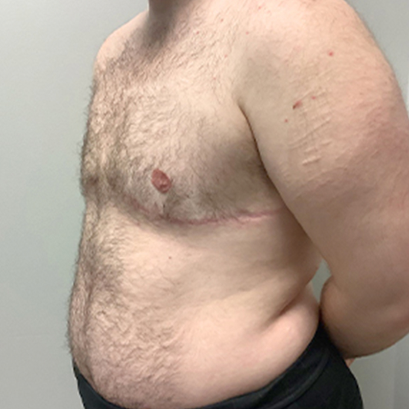 Female To Male Top Surgery 03