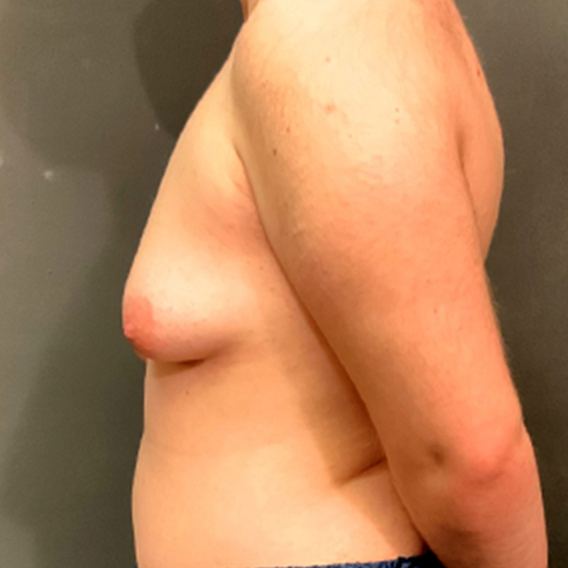 Female To Male Top Surgery 05