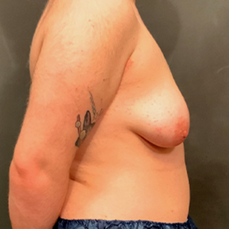 Female To Male Top Surgery 07