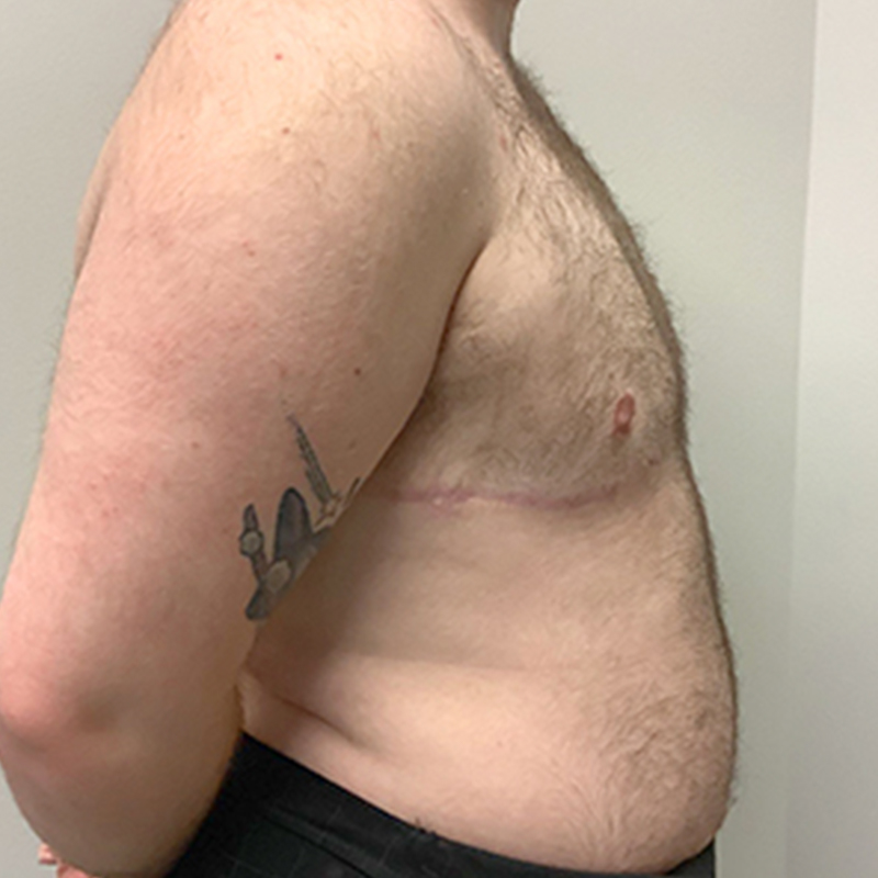 Female To Male Top Surgery 07