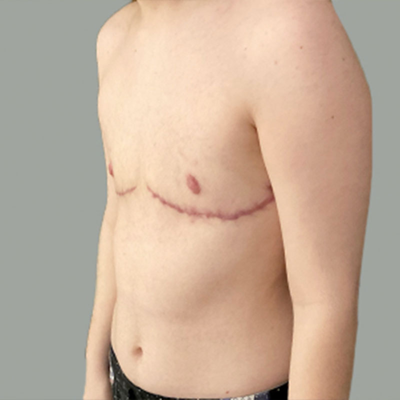 Female To Male Top Surgery 03