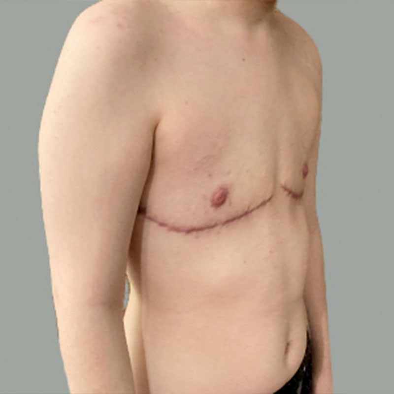 Female To Male Top Surgery 07