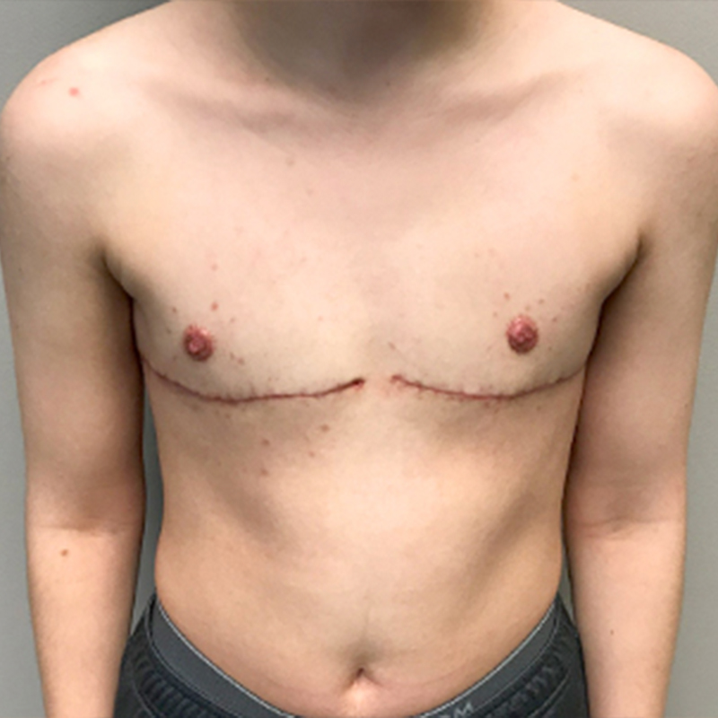 Female To Male Top Surgery 99