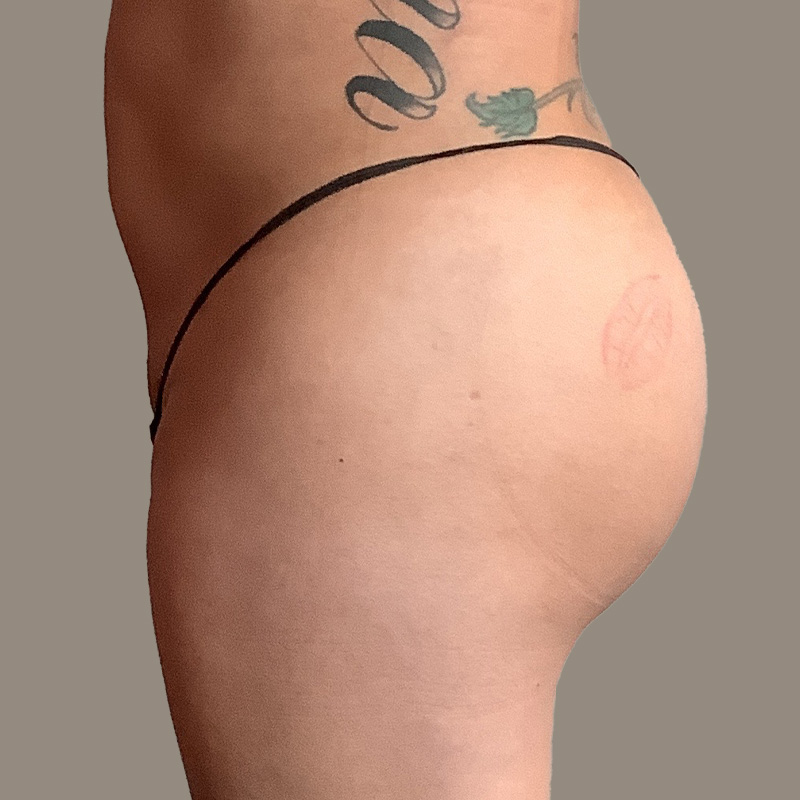 Ftm Body Contouring 05