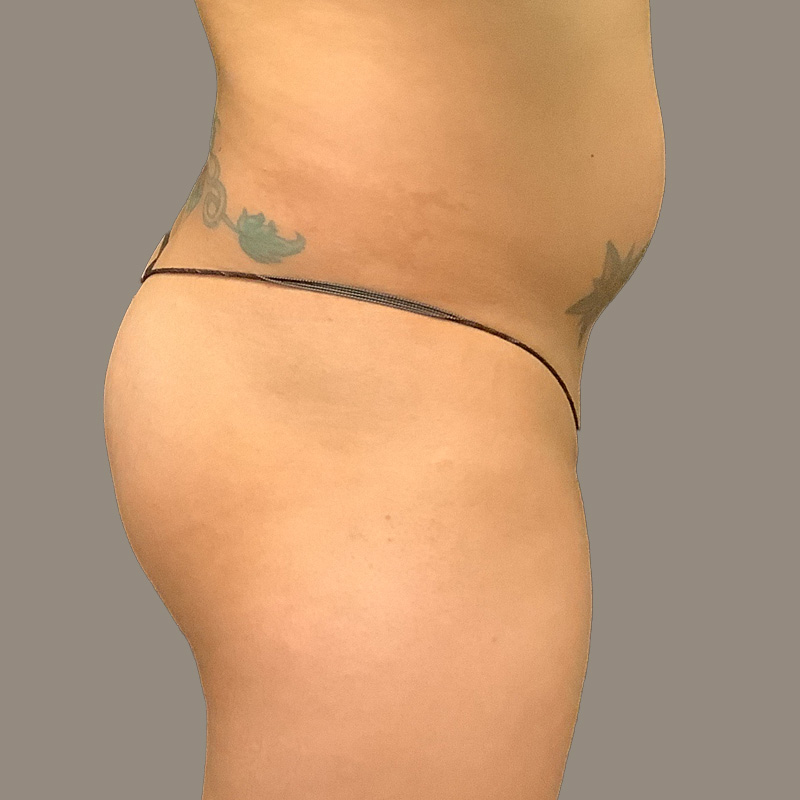 Ftm Body Contouring 07