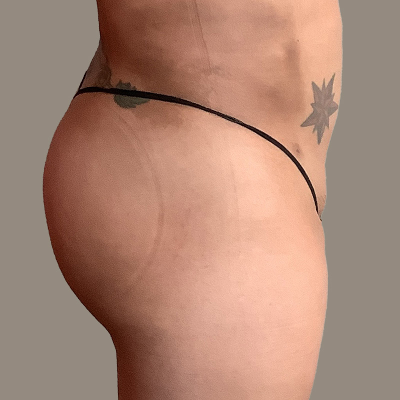 Ftm Body Contouring 07