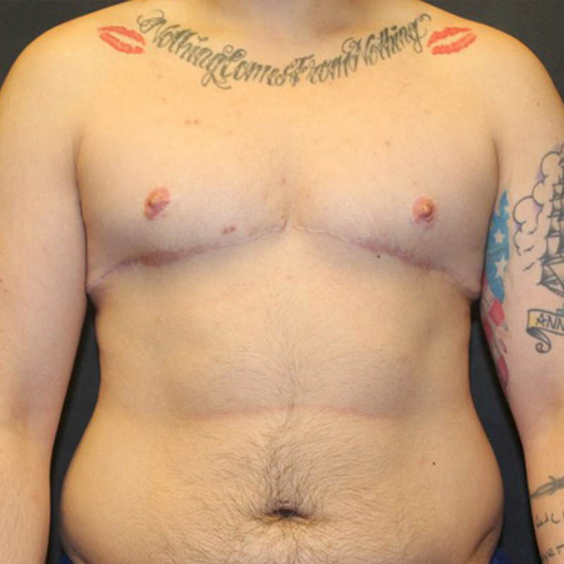 Ftm Body Contouring 01