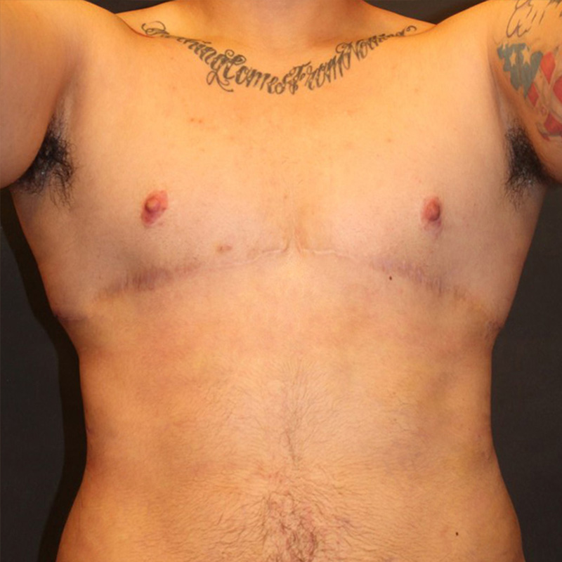 Ftm Body Contouring 02