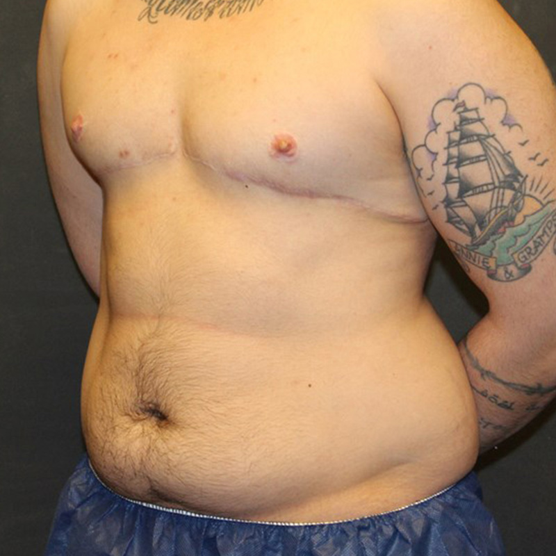 Ftm Body Contouring 05