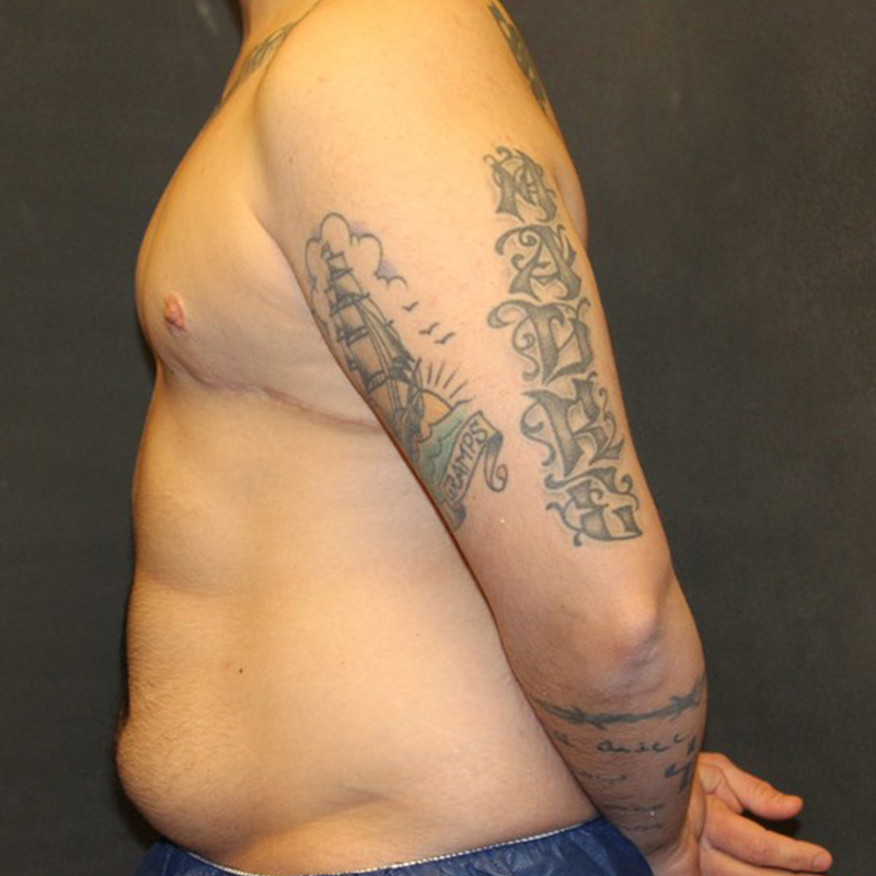 Ftm Body Contouring 07