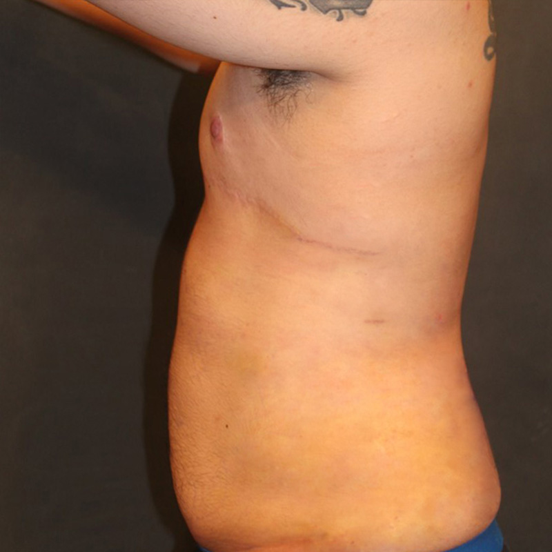 Ftm Body Contouring 07