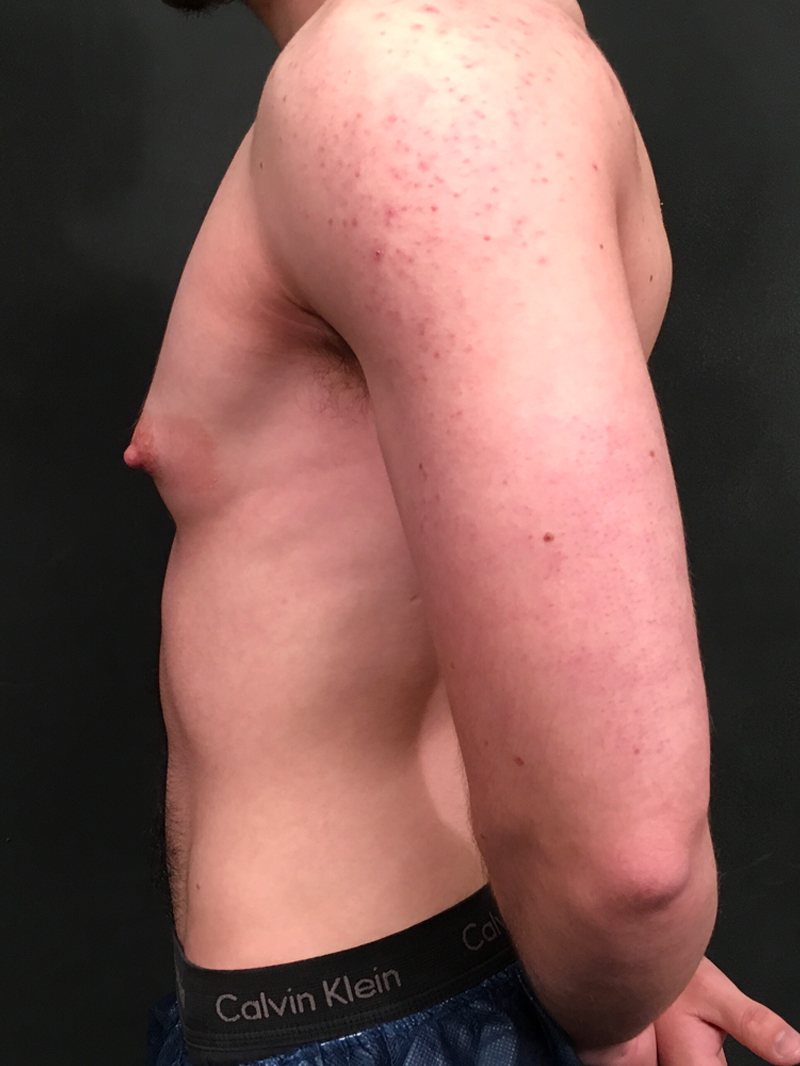 Ftm Body Contouring 05