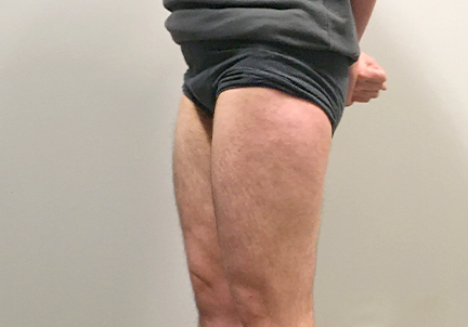 Ftm Body Contouring 04