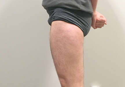 Ftm Body Contouring 05