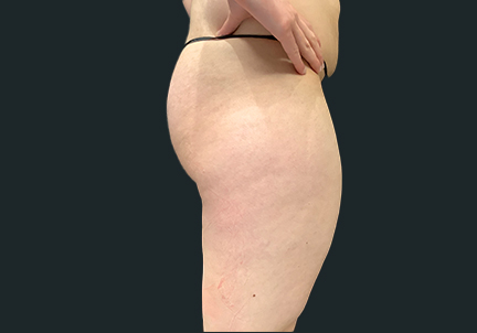 Ftm Body Contouring 07