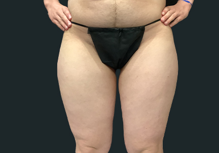 Ftm Body Contouring 09