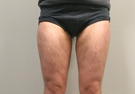 Ftm Body Contouring 09