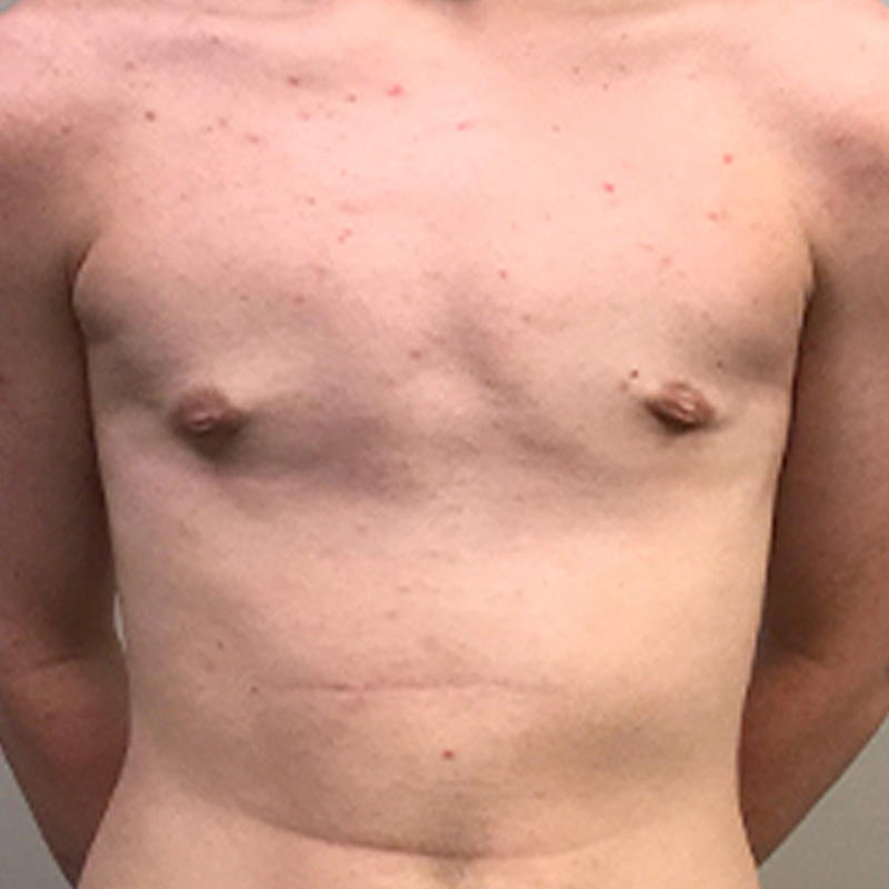 Ftm Keyhole Chest Reconstruction 01