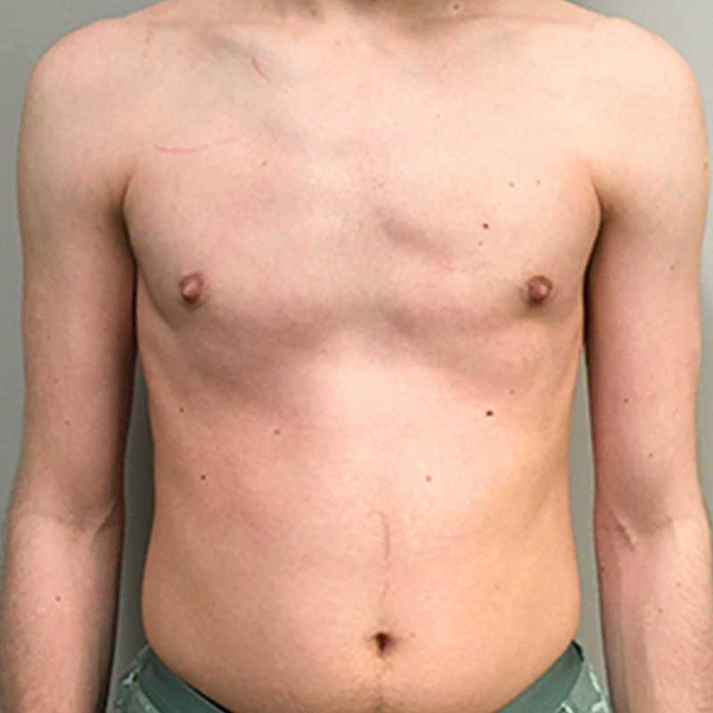 Ftm Keyhole Chest Reconstruction 02