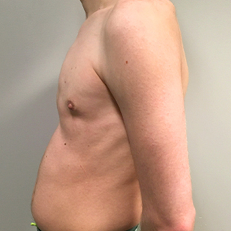 Ftm Keyhole Chest Reconstruction 05