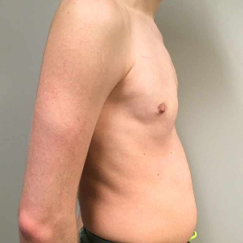 Ftm Keyhole Chest Reconstruction 09