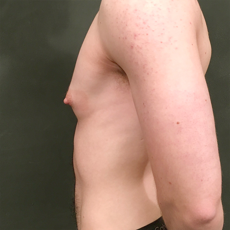 Ftm Keyhole Chest Reconstruction 05