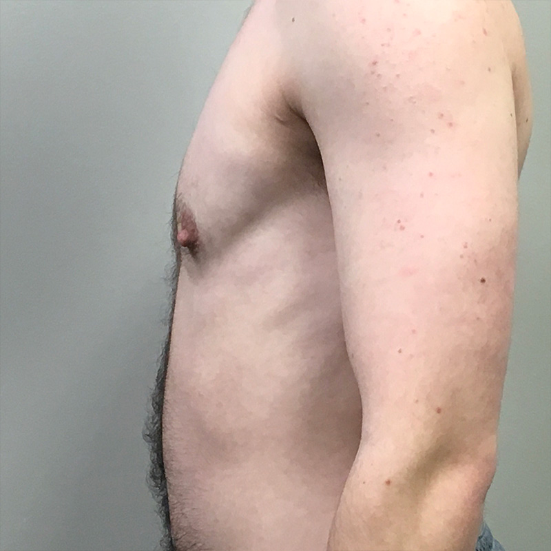 Ftm Keyhole Chest Reconstruction 05