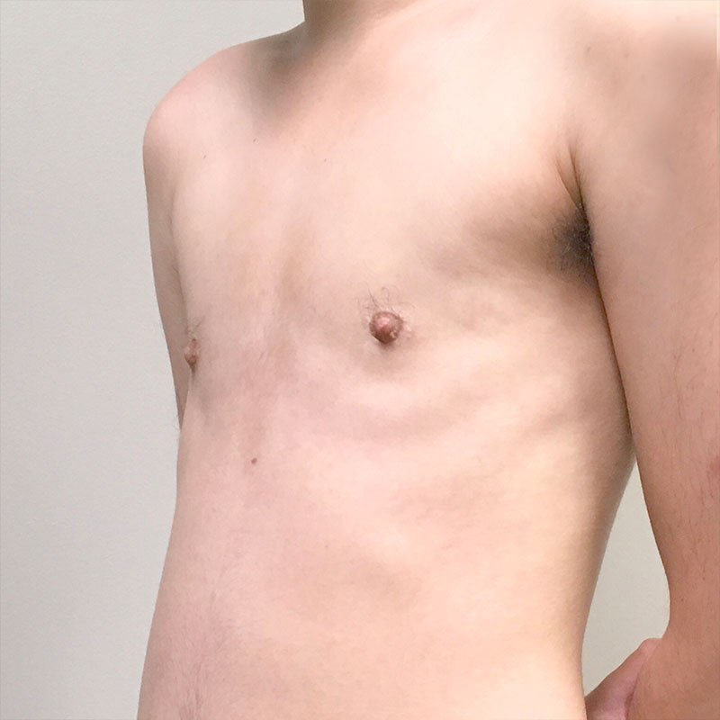 Ftm Keyhole Chest Reconstruction 03