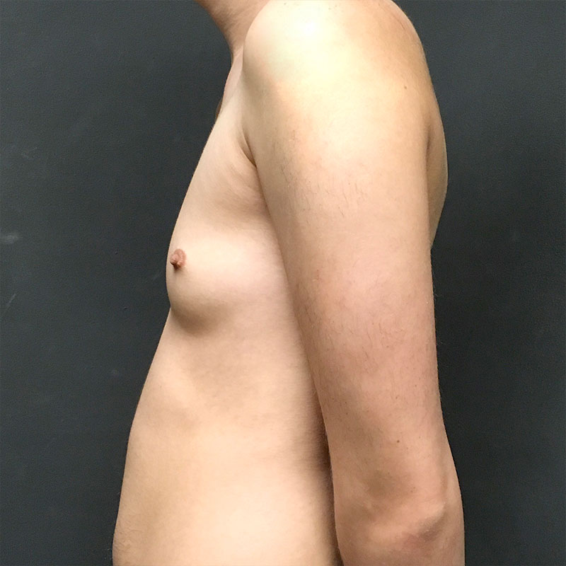 Ftm Keyhole Chest Reconstruction 05