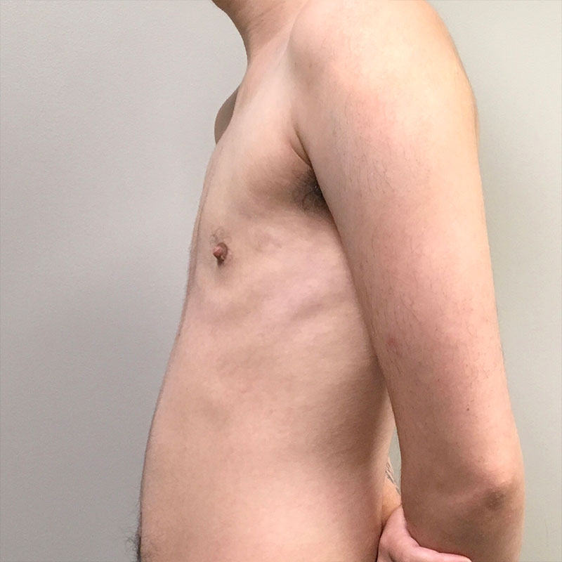 Ftm Keyhole Chest Reconstruction 05