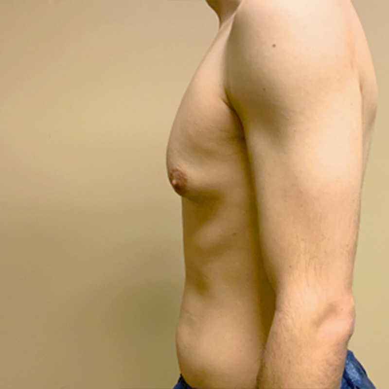 Ftm Keyhole Chest Reconstruction 03