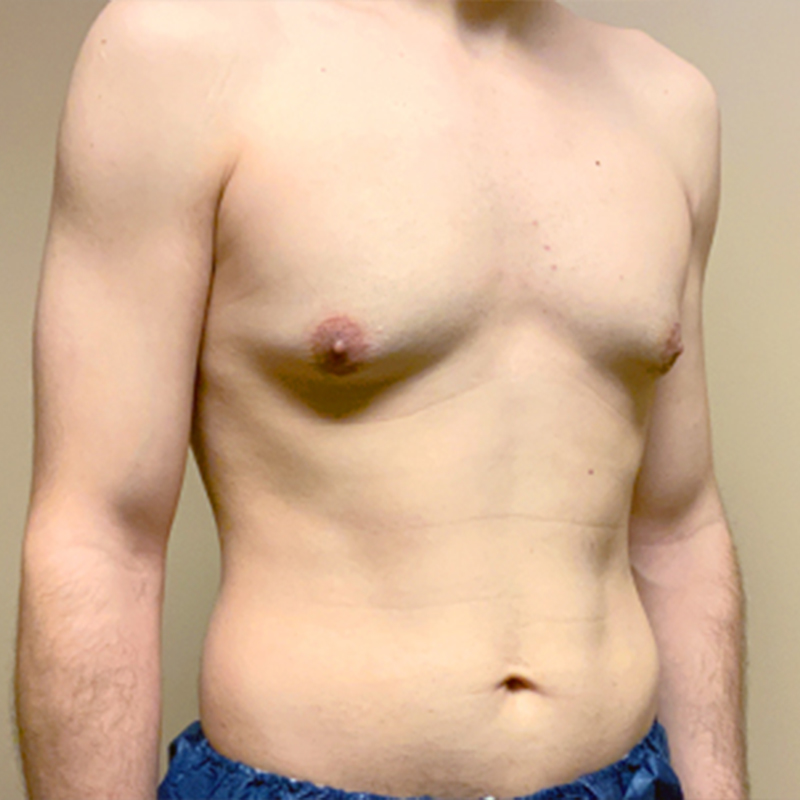 Ftm Keyhole Chest Reconstruction 05