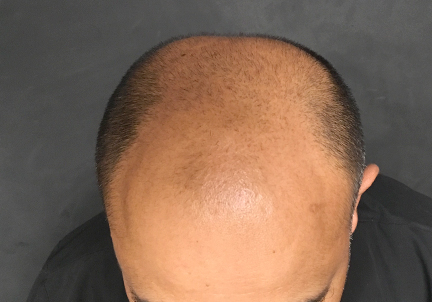 Fue Hair Transplant 01