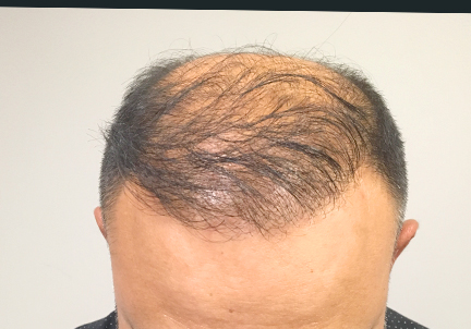Fue Hair Transplant 01