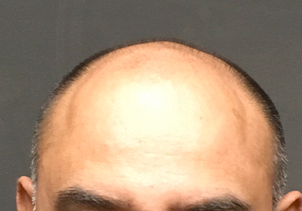 Fue Hair Transplant 03