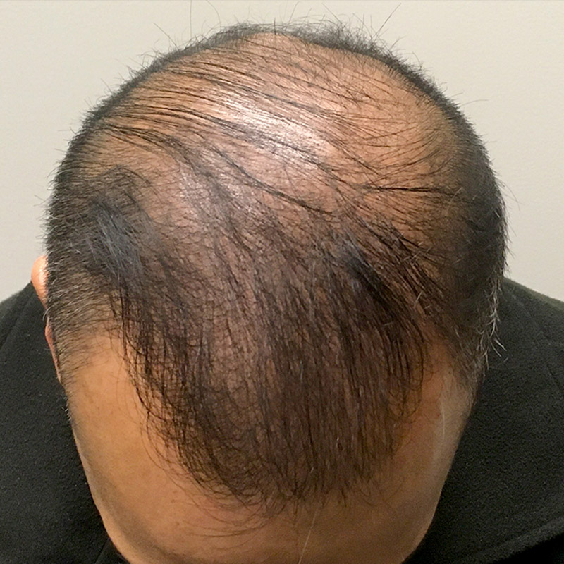 Fue Hair Transplant 02