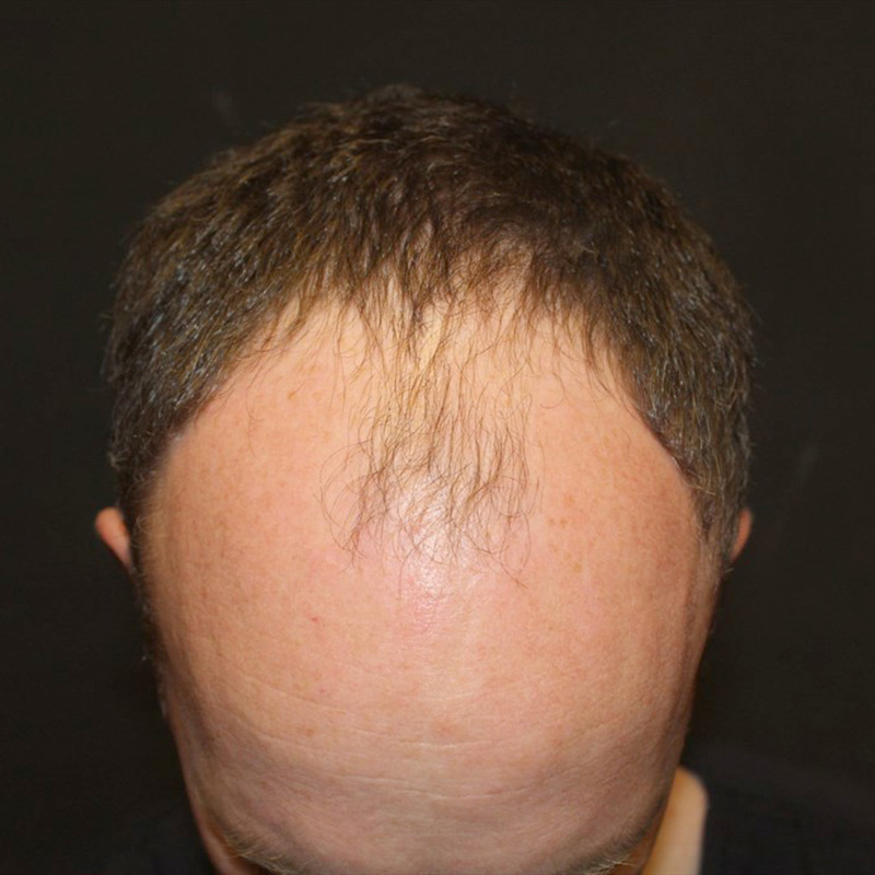 Fue Hair Transplant 01