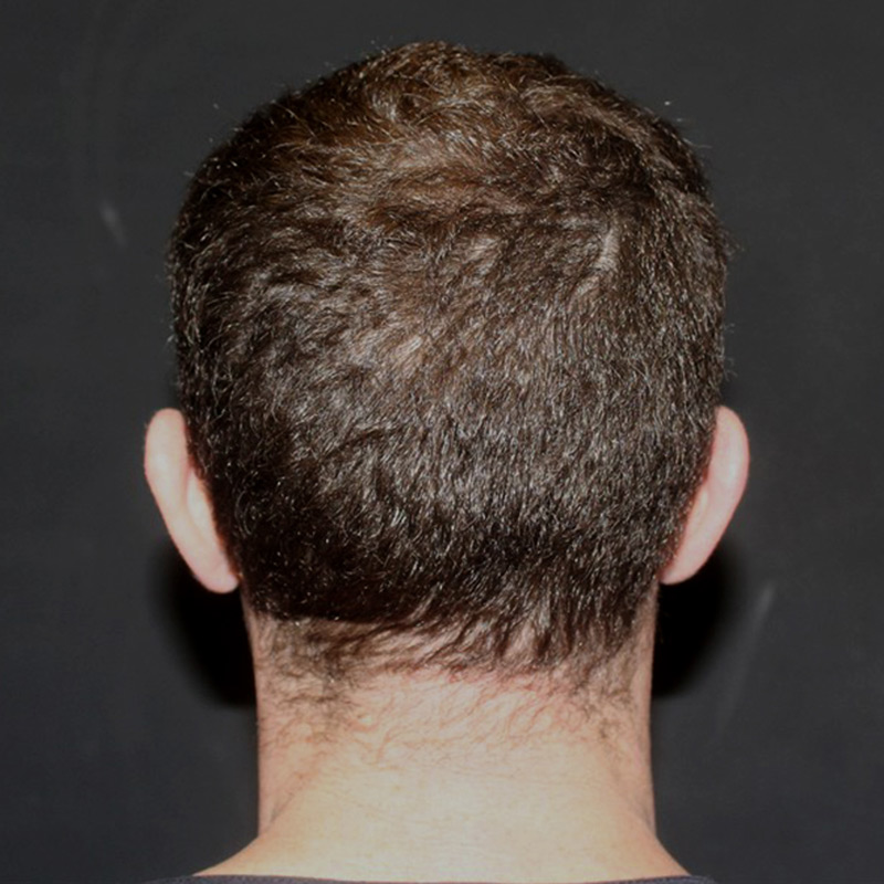 Fue Hair Transplant 03
