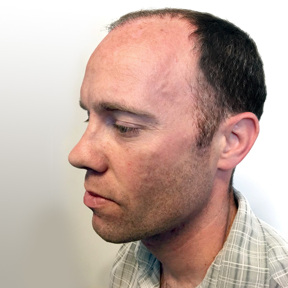 Fue Hair Transplant 07