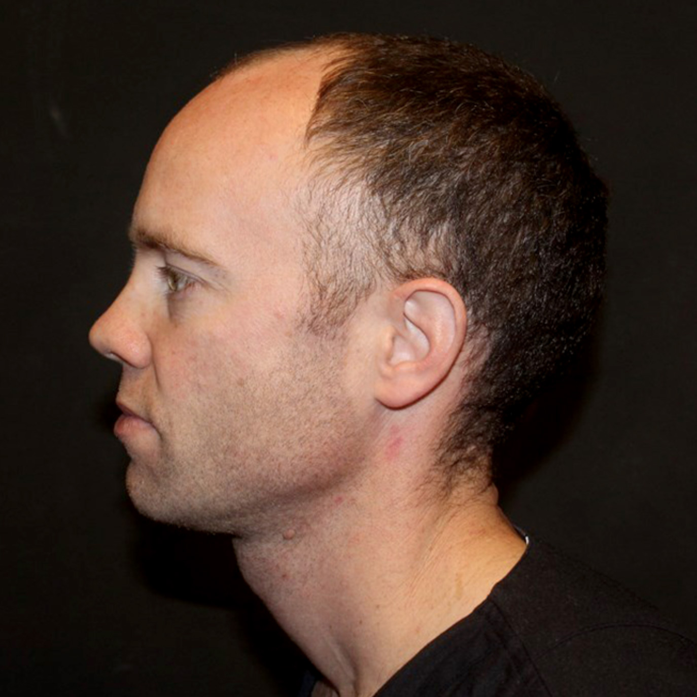 Fue Hair Transplant 09