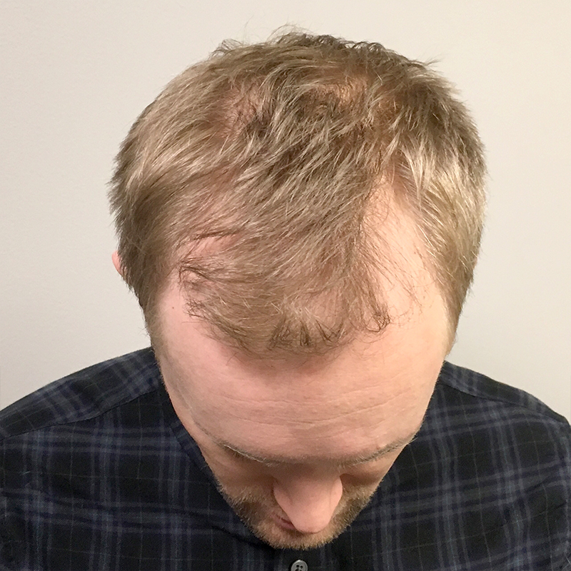 Fue Hair Transplant 01