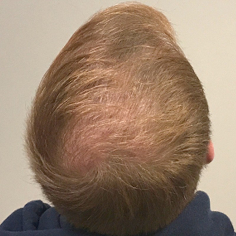 Fue Hair Transplant 08