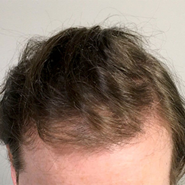 Fue Hair Transplant 01