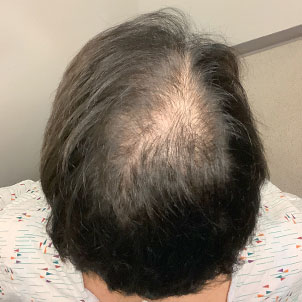 Fue Hair Transplant 01