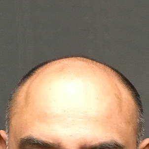 Fue Hair Transplant 03