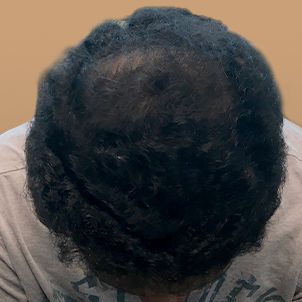 Fue Hair Transplant 13